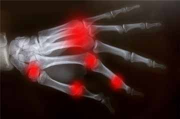 Inflammation